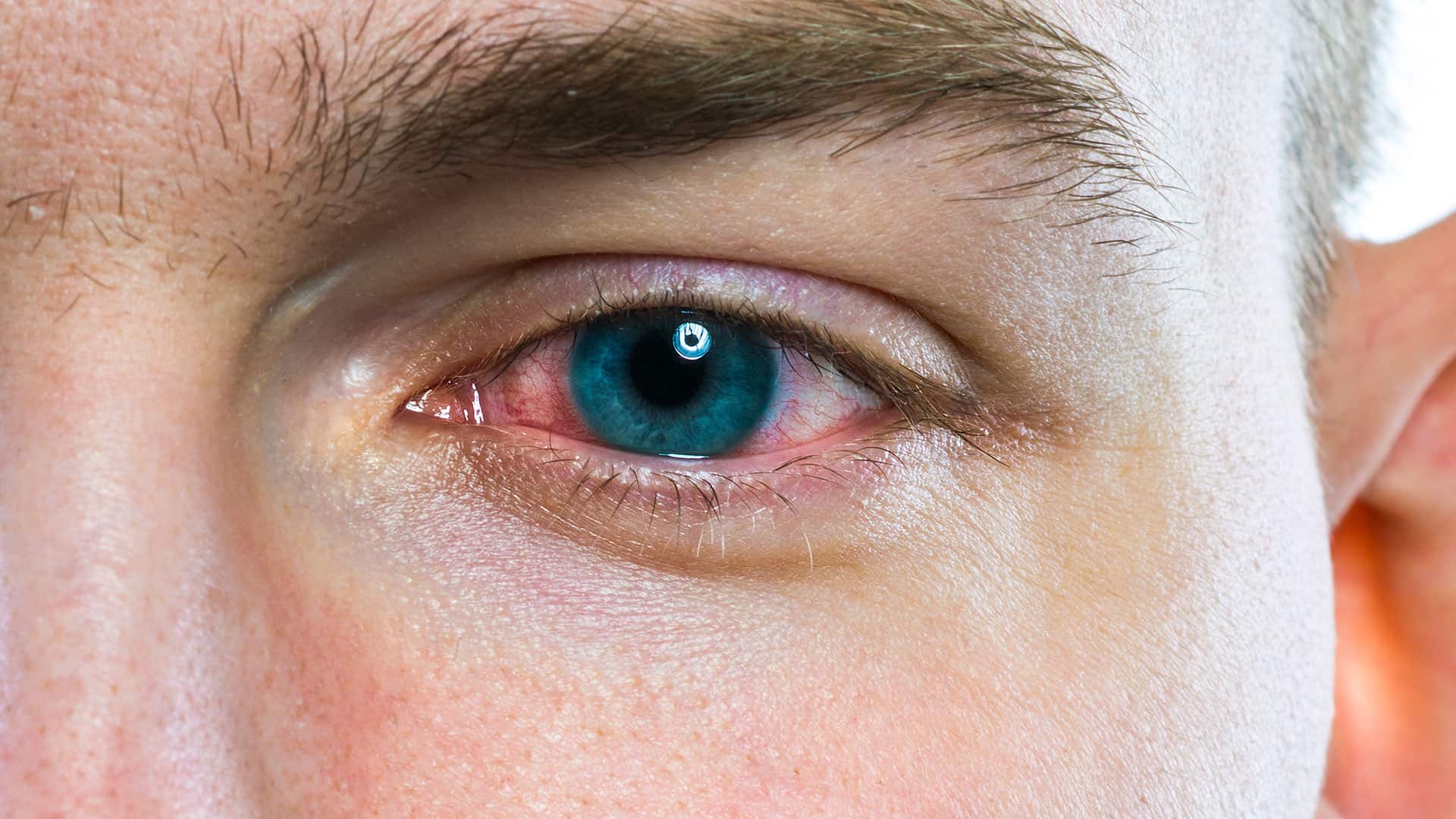 Why you should wear dark sunglasses? If you have conjunctivitis